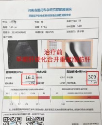 baidu09显著改善肝组织病变，NASH创新疗法公布3期试验更多积极结果