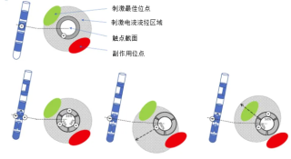 国内AI+脑机接口双驱！产品从研发走向临床，有望恢复动物视力