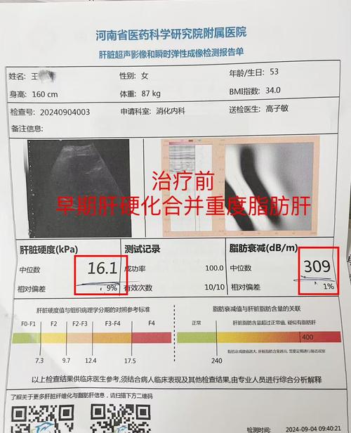 baidu09显著改善肝组织病变，NASH创新疗法公布3期试验更多积极结果  第1张