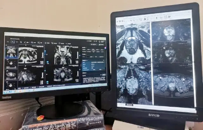 聚焦前列腺癌早筛早诊！仁济医院“医生+ AI”协作阅片，助力影像精准诊断  第1张