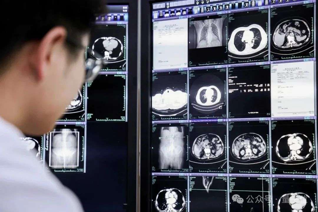 这个AI能救命！提前6个月发现胃癌病灶，突破医学影像认知，达摩院做成了  第6张