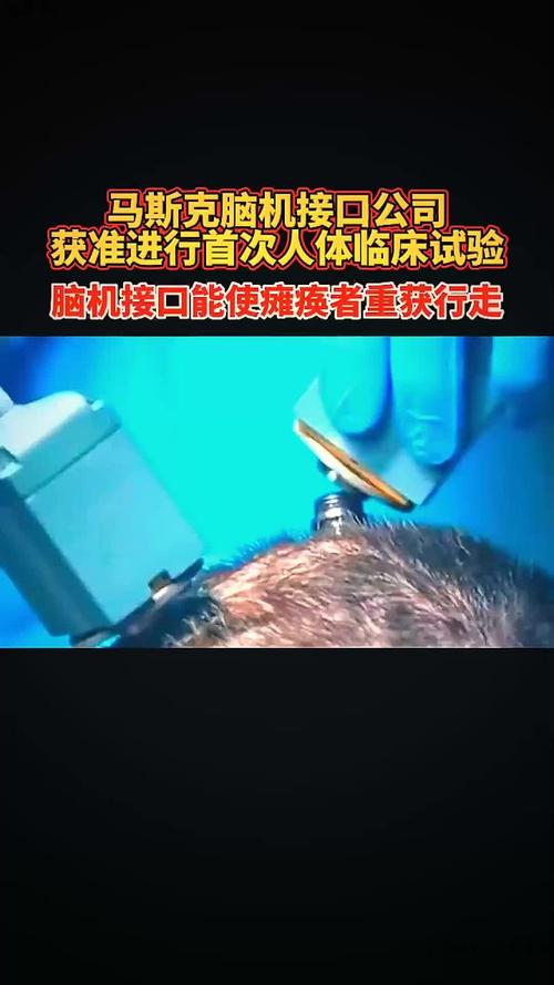 百度拜读09baidu马斯克称脑机接口技术有望治疗早期阿尔茨海默症  第1张